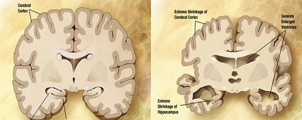 Найдена иммунная дисфункция, ускоряющая развитие болезни Альцгеймера